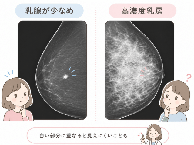 高濃度乳房乳腺の白さに重なると、見えにくいことがあります
