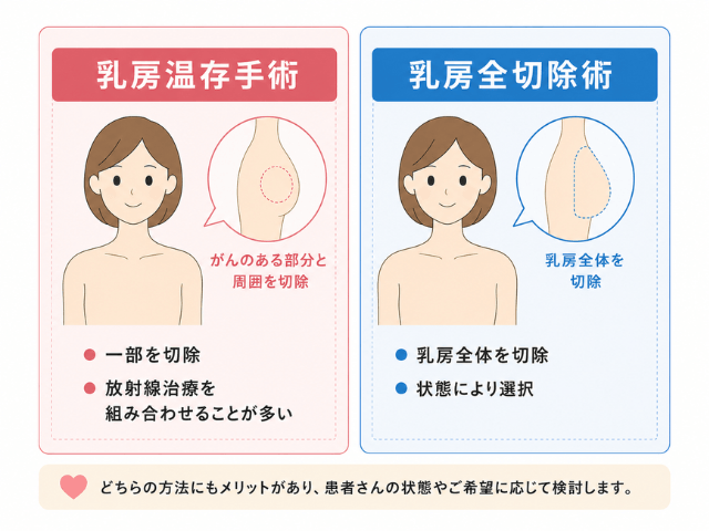乳房温存手術と乳房全切除術の違いをやさしく整理した資料風イラスト