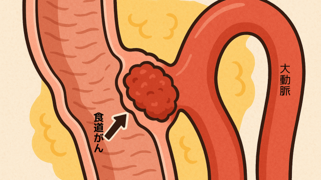 食道がんと大動脈のイラスト